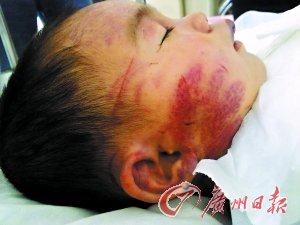 ��Ű��3�qŮͯ ��������X��Ѫ���ڱ�؃�